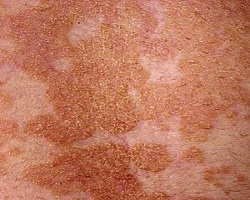 Pityriasis versicolor 2